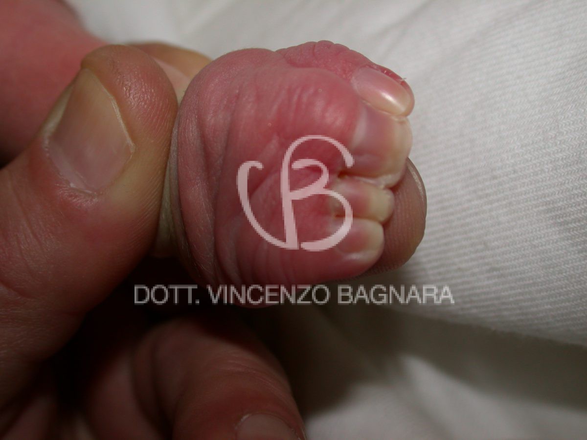 Aspetto della mano destra alla nascita - Prof. Vincenzo Bagnara